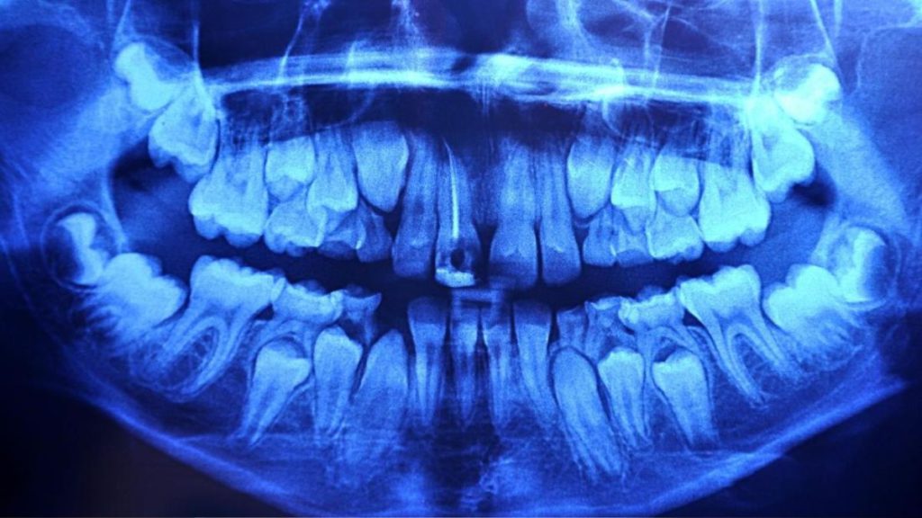 Deep learning algorithm interprets dental Xrays to detect periodontal