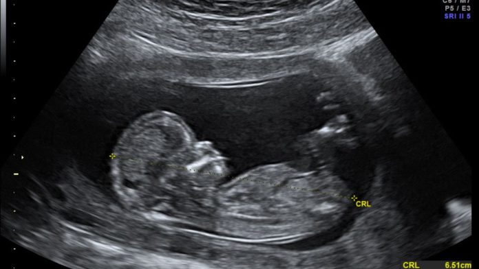 AI diagnoses birth defects in fetal ultrasound images