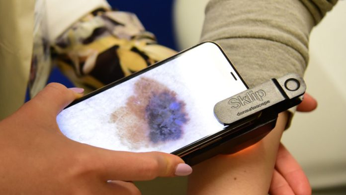 Sklip AI dermatoscope identifies skin cancer